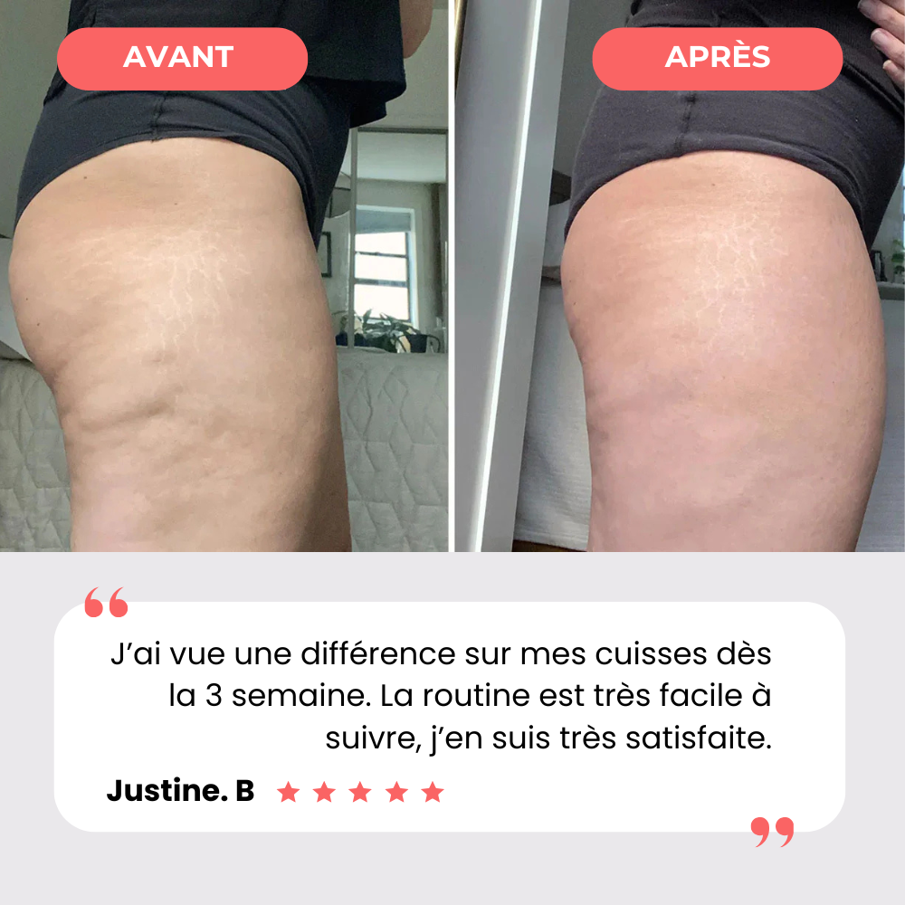 Masseur Anti-Cellulite | EvoriaSkin