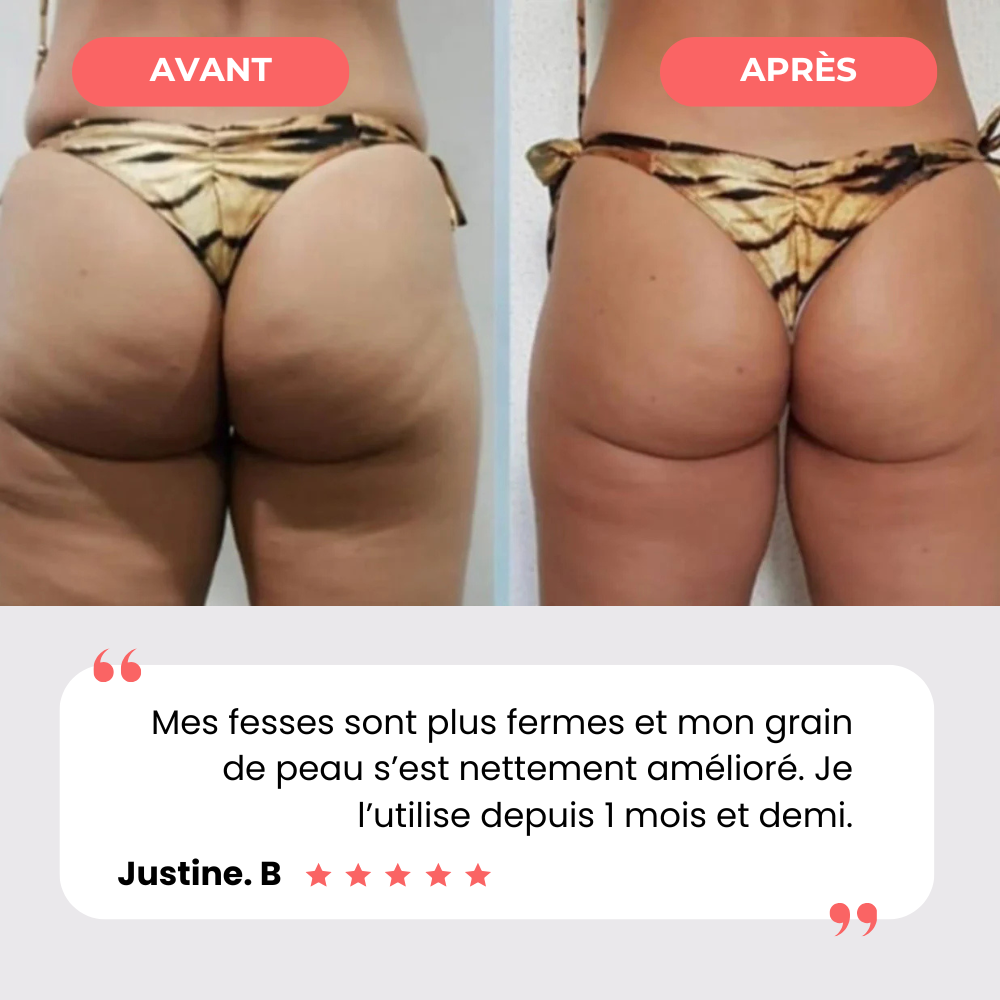 Masseur Anti-Cellulite | EvoriaSkin