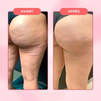 Masseur Anti-Cellulite | EvoriaSkin