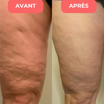 Masseur Anti-Cellulite | EvoriaSkin